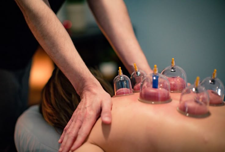 Hijama Therapy